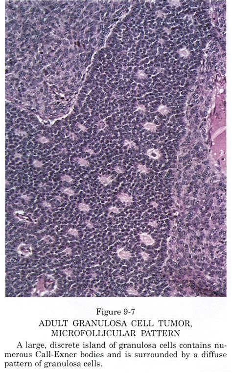 Pathology Outlines Granulosa Cell Tumor Adult