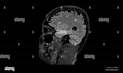 Mrt Hirnscan Sagittales Flair Zur Erkennung Von Hirnerkrankungen Sush