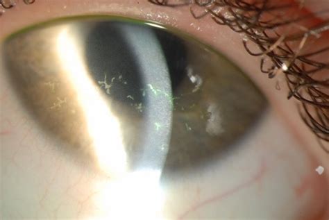 Herpes Zoster Ophthalmicus Eyeonoptics