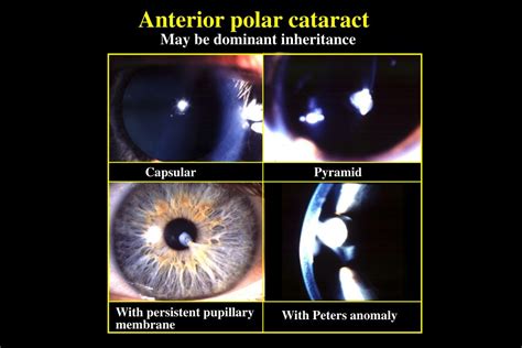 Ppt Congenital Cataract Powerpoint Presentation Free Download Id