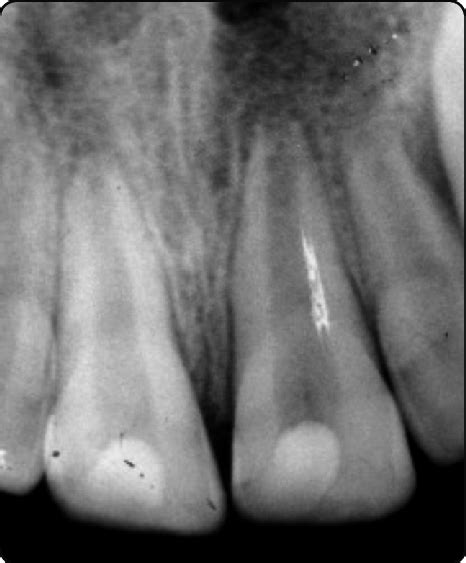 Initial Radiographs Showing Incomplete Root Formation With Open Apices