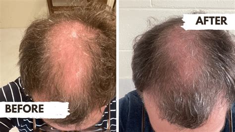 Regrow Hair Clinics Before And After Images