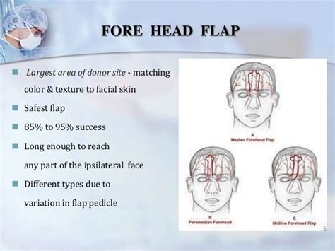 scope of Pedicled flaps in oral and maxillofacial surgery