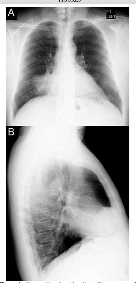 Figure 1 From Solitary Fibrous Tumor Of Pleura A Case Report And