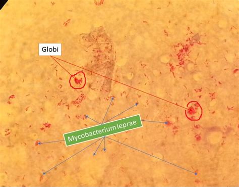 Staining Of Mycobacterium Leprae Leprosy Bacilli By Modified Ziehl Neel