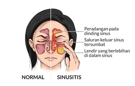 Manajemen Dan Tatalaksana Sinusitis