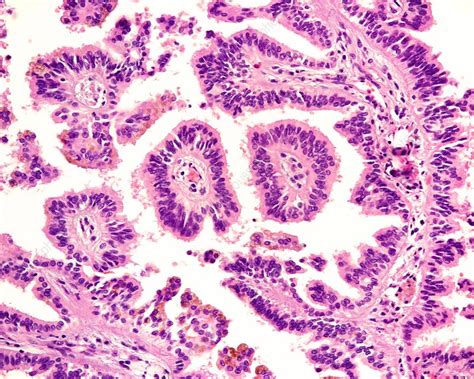 Human Renal Cell Carcinoma Light Micrograph Stock Image C