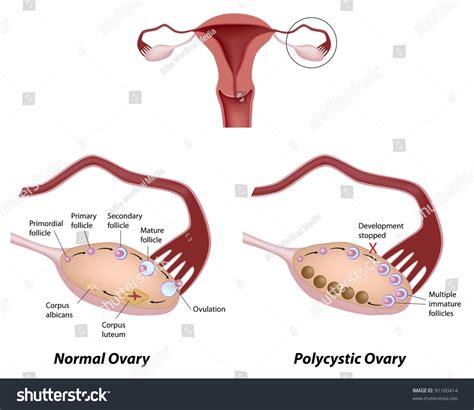 Normal Ovarian Cycle Polycystic Ovary Syndrome Stock Illustration