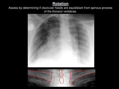 Ppt The Complete Idiot’s Guide To Reading The X Ray Powerpoint Presentation Id 583063