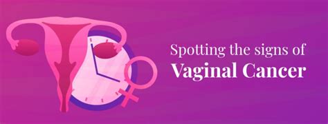 Vaginal Cancer Symptoms And Causes Rela Institute