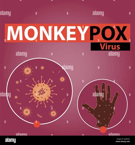 Ein Vektor Illustration Banner Design F R Das Monkeypox Virus Virale