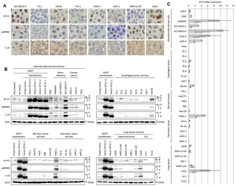 Differential Detection Of Cytoplasmic Wilms Tumor 1 Expression By