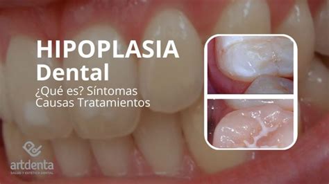 Qué es Hipoplasia dental Síntomas Causas Tratamientos Clínica