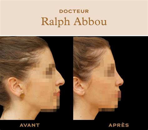 Rhinoplastie avant après Paris Dr Abbou chirurgie esthetique