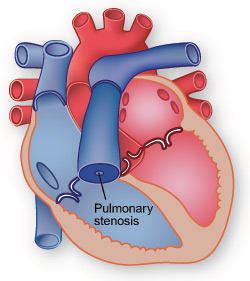 Pulmonary Valve Stenosis: Symptoms, Diagnosis & Treatment