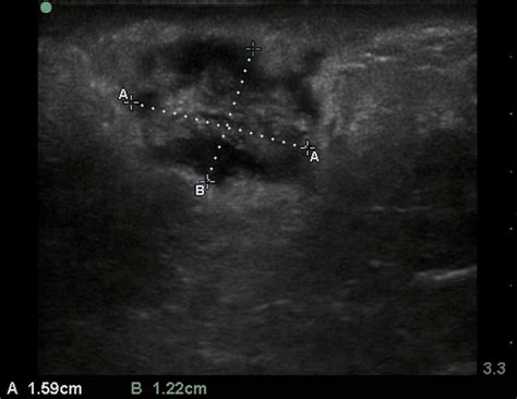 Infecting The Masses Soft Tissue Infections And Ultrasound Emra