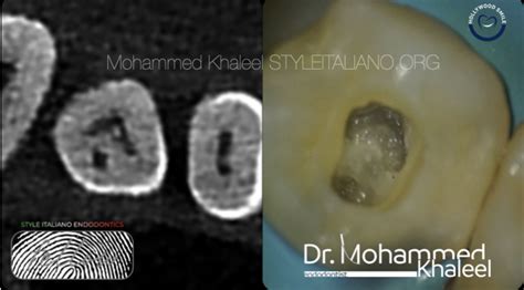 Dens invaginatus - Style Italiano Endodontics