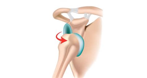 Shoulder Subluxation - Shoulder Instability - Symptoms, Causes, Exercises