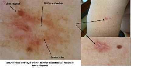 Dermoscopy Made Simple Dermatofibroma