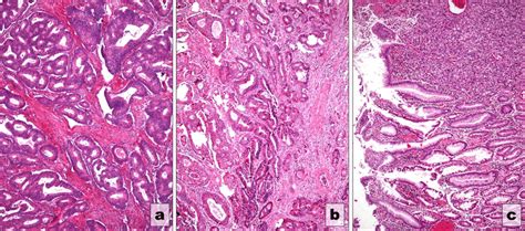 Tumor Grading A Well Differentiated Adenocarcinoma B Moderately