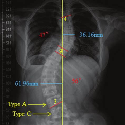 Pdf Distal Adding On Phenomenon In Adolescent Idiopathic Scoliosis