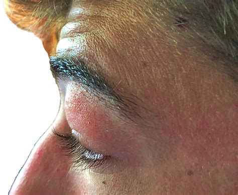 Upper Eyelid Infection