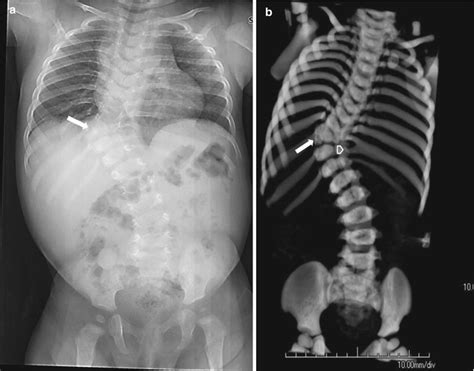 The Spine Congenital And Developmental Conditions Radiology Key