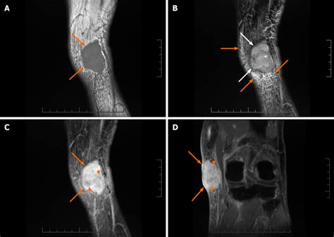 Magnetic Resonance Images Of The Malignant Peripheral Nerve Sheath