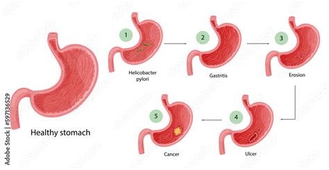 Stomach Diseases Diagram Of Diseases Of Helicobacter Pylori Gastritis Erosion Ulcer And