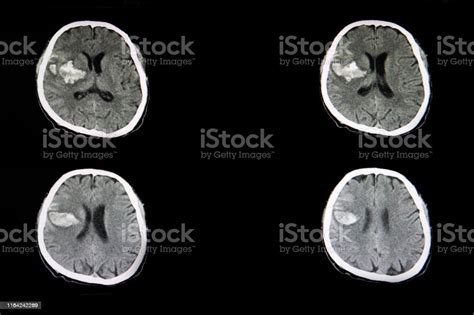 Tomografía Computarizada De Un Brian De Un Paciente Con Accidente