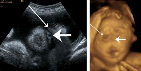 Cyclopia Ultrasound