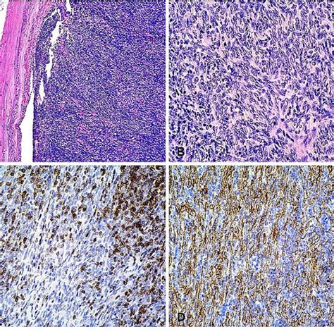 Case 1 Photomicrographs Hematoxylin And Eosin Stained Sections A