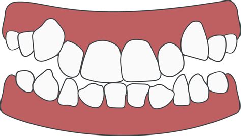 Orthodontic Problem Teeth Crowding Abnormal Eruption Opposite