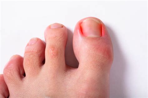 Ingrown Toenail Surgery Gentle Podiatry