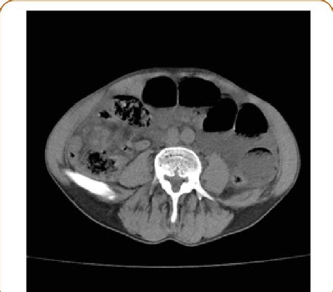 Free Fluid In Abdominal Cavity And Thickened Intestinal Walls With