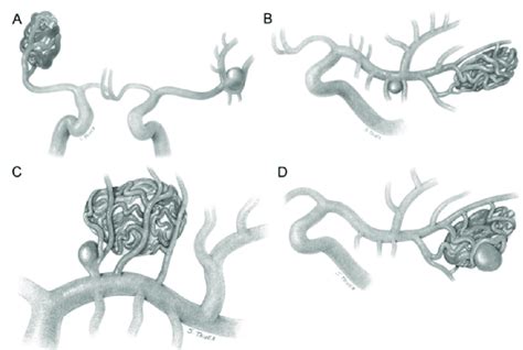 Classification of AVM associated with aneurysm showing unrelated ...