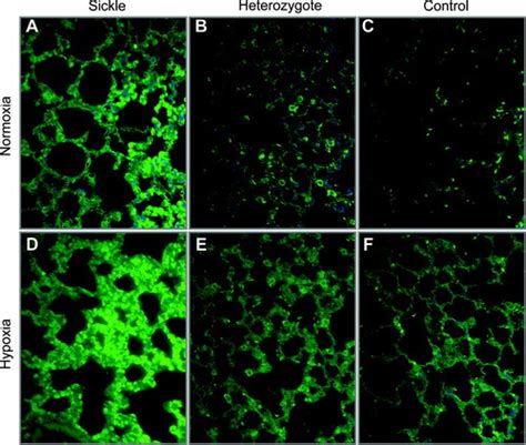 Hypoxia Induced Acute Lung Injury In Murine Models Of Sickle Cell