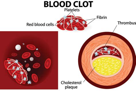 Blood Clots during Pregnancy - Motherhood Tips