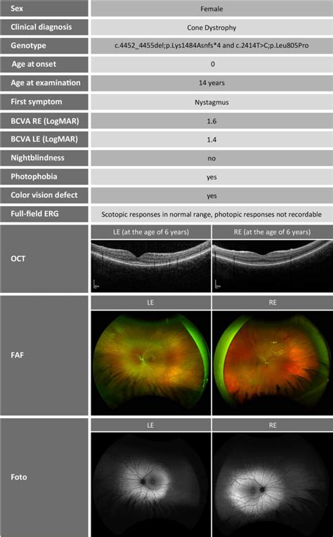 An Early Onset Cone Dystrophy Due To Cep Mutation A Case Report