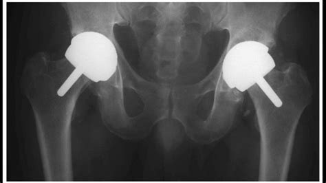 Birmingham Hip Resurfacing Complications