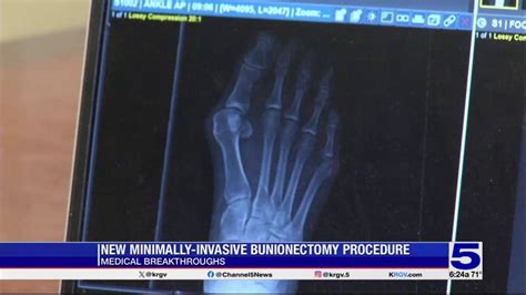 Medical Breakthrough: New minimally-invasive bunionectomy procedure