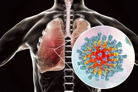 Virus De La Rougeole Dans L Appareil Respiratoire Humain Illustration