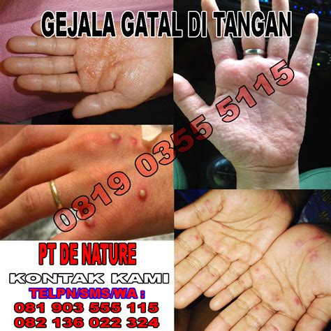 2 Harga Dan Jenis Obat Gatal Di Tangan Bintik Berair Di Apotik