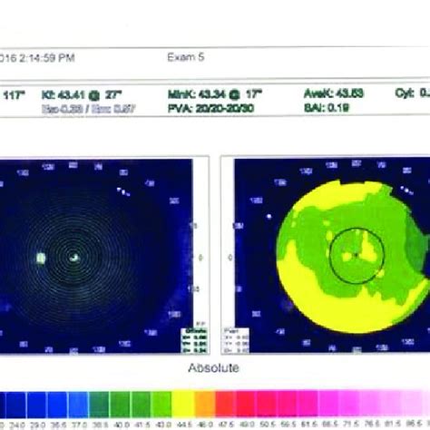 Postoperative Corneal Topography Map Of The Right Eye Download Scientific Diagram