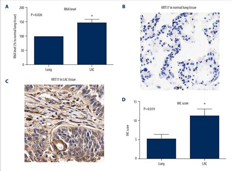 Figure From Keratin Promotes Lung Adenocarcinoma Progression By