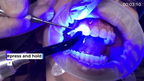 Carriere Motion 3d Clear Class Ii Bonding Dr Paquette And Henry Schein Orthodontics Youtube