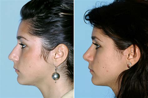 Expert Rhinoplasty For Refining Broad Nose Bridges