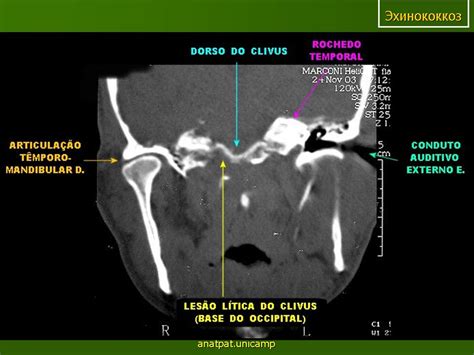 ГМ. Эхинококкоз. + | Портал радиологов