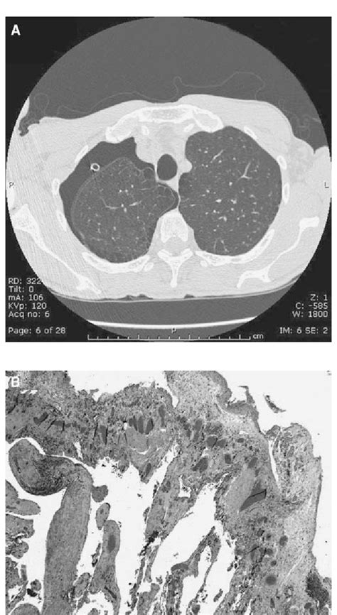 Figure From Exclusive Intrapulmonary Lepidic Growth Of A Malignant