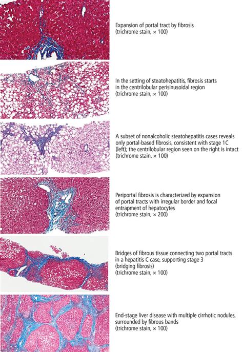 Liver Fibrosis Stages